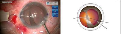 Case report: Double-armed flanged polypropylene suture for repairing wide iridodialysis